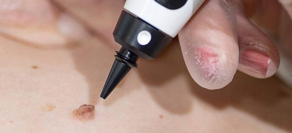 After Skin Tag Removal Ossett