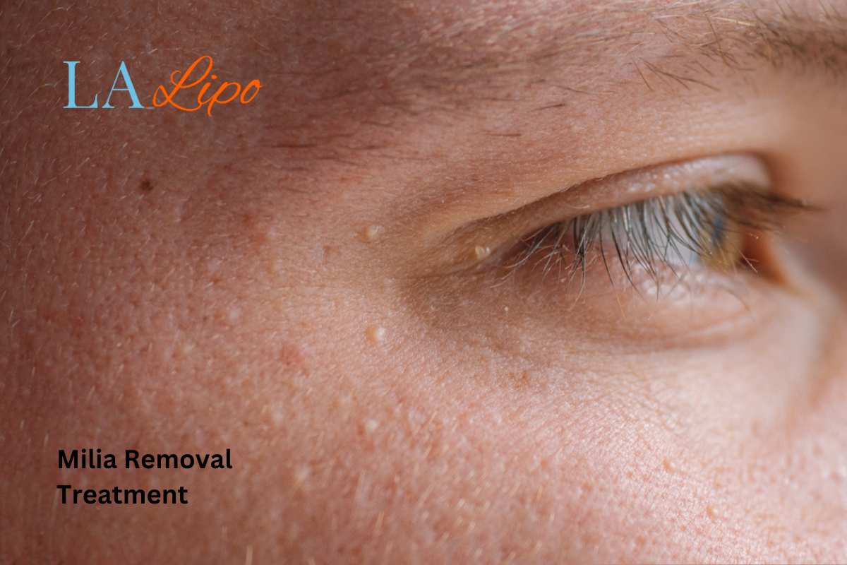 Cryopen Milia Removal: Is It the Easiest and Safest Option Ossett?
