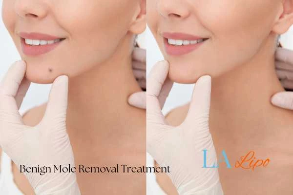 Before-and-after results following benign mole-removal treatment Ossett
