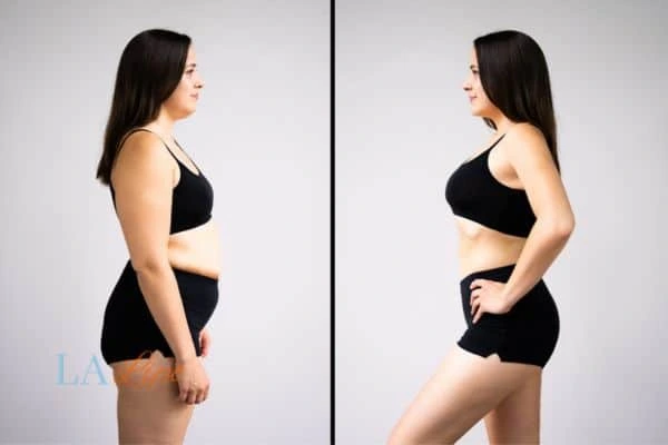 image of woman before and after results of LA-EMS Body Sculpting Ossett to help treat Diastasis recti