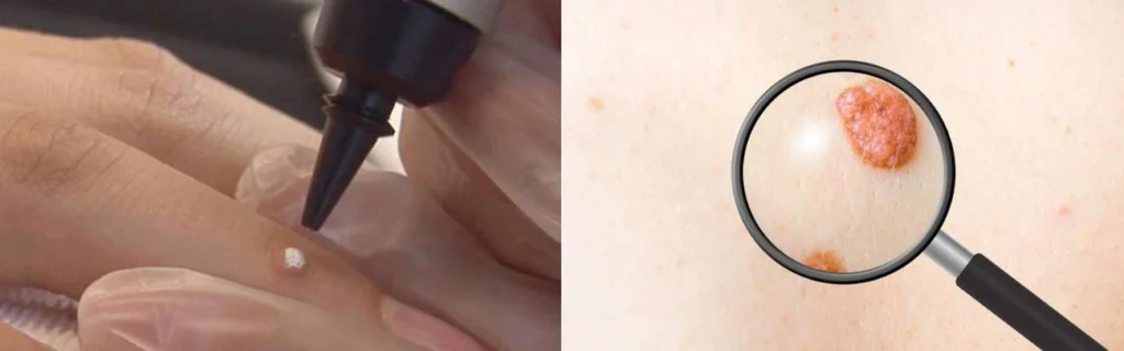 CryoPen practitioner Ossett assessing a benign mole before treatment