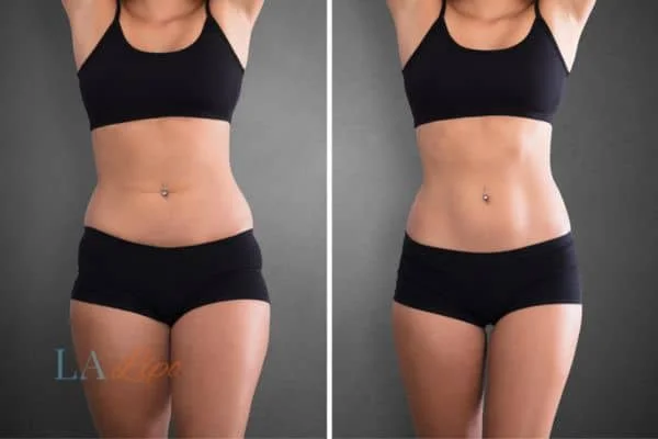 before and after results of non-surgical treatment to help a woman's body image and mental health Ossett
