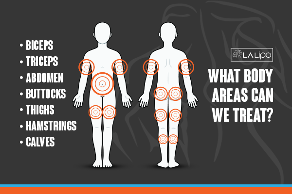 Diagram to show areas you can have LA-EMS Body Sculpting Treatment Ossett