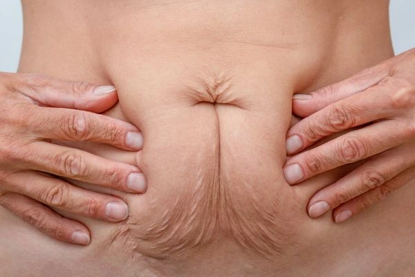 Image of a woman's stomach with loose skin - example of skin tightening Ossett options