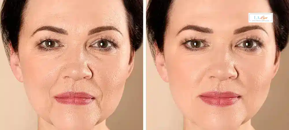 How Long Does It Take to See Results and How Long Do They Last Ossett?