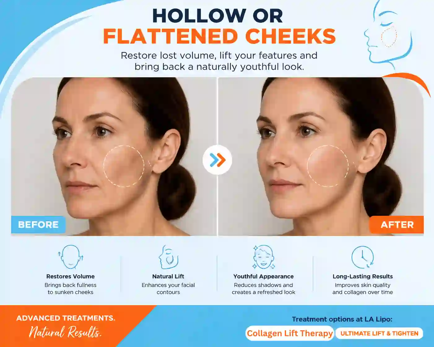 Sign #4: Hollow or Flattened Cheeks Ossett